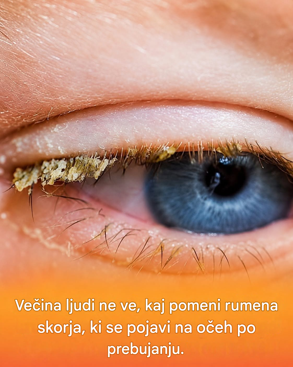 Rumena skorja po prebujanju: kako razumeti naravno čiščenje oči ponoči