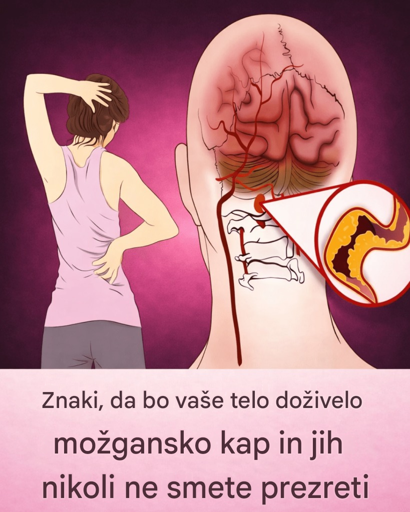 10 zgodnjih opozorilnih znakov kapi, ki bi jih moral poznati vsak, da bi lahko pravočasno ukrepal