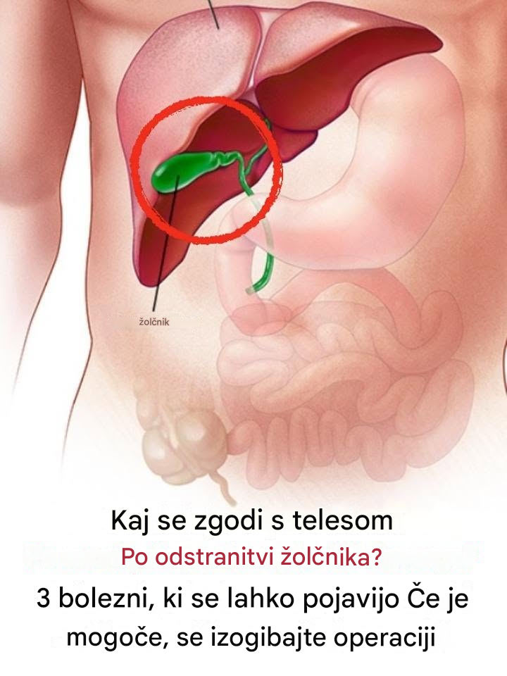 Kaj se zgodi z vašim telesom po odstranitvi žolčnika? 3 bolezni, ki lahko povzročijo odstranitev žolčnika – če je mogoče, se izogibajte operaciji