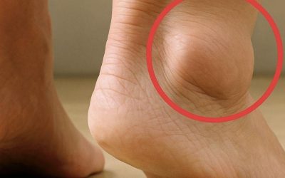 Otekle noge pri starejših odraslih: pogosti vzroki in preprečevanje