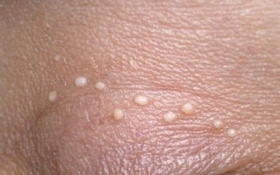 Na mojih vekah se nenehno pojavljajo drobne bele izbokline in še ne morem priti na pregled. Kaj so to? Drobne bele izbokline, ki se pojavljajo na vekah, so lahko zavajajoča in moteča težava. Čeprav so pogosto neškodljive, lahko povzročijo nelagodje ali zadrego, negotovost glede njihove narave pa lahko vodi v tesnobo. Žal je lahko pravočasen obisk dermatologa ali oftalmologa izziv, zaradi česar ste v negotovosti. V tem članku bomo raziskali, kaj bi lahko bile te drobne bele izbokline, zakaj nastanejo in kako jih lahko obravnavate, medtem ko čakate na pregled pri zdravstvenem delavcu. Obravnavali bomo tudi razlike med temi izboklinami in drugimi pogostimi težavami z vekami, kot sta ječmen in kalazija, ter podali nasvete o preprečevanju in varni negi na domu. 1. Kaj so običajno drobne bele izbokline na vekah Drobne bele izbokline na vekah so najpogosteje znane kot milie. Milie so majhne, ​​s keratinom napolnjene ciste, ki se oblikujejo tik pod površino kože. Običajno so velike od 1 do 2 milimetra in imajo biserno bel videz. Za razliko od aken milij ne povzročajo zamašene pore ali bakterijske okužbe. Milije se lahko pojavijo v kateri koli starosti in so še posebej pogoste pri novorojenčkih. Lahko pa se razvijejo tudi pri odraslih, zlasti okoli oči, kjer je koža občutljiva in tanka. Običajno so neškodljive in niso povezane z nobenim osnovnim zdravstvenim stanjem. 2. Milije 101: Zakaj se te majhne ciste oblikujejo okoli oči Milije nastanejo, ko se odmrle kožne celice ujamejo v majhne žepke blizu površine kože, namesto da bi se naravno luščile. Ta ujeti keratin postane drobna cista. Nastanek milij ni povsem razumljen, vendar velja, da je povezan s poškodbami kože, na primer zaradi izpostavljenosti soncu ali uporabe močnih izdelkov za nego kože, ki lahko zamašijo površino kože. Predel okoli oči je še posebej nagnjen k milijam, ker je koža tanjša in bolj občutljiva na okoljske poškodbe in kopičenje izdelkov. Ljudje, ki uporabljajo goste kreme ali močno ličilo okoli oči brez ustreznega čiščenja, so lahko bolj dovzetni za razvoj milij. 3. Kako ločiti milije od ječmena, halaziona ali belih ogrc Razlikovanje milij od drugih stanj vek je bistvenega pomena za pravilno zdravljenje. Milije so čvrste, bele in neboleče izbokline, ki se ne spreminjajo bistveno po velikosti. Čmiček pa je rdeča, boleča bulica blizu roba veke, ki jo povzroči okužba oljnice. Čmički so pogosto občutljivi na dotik in lahko povzročijo otekanje veke. Halazij je podoben čmičku, vendar je običajno večji, manj boleč in se pojavi dlje zadaj na veki. Halazije nastanejo zaradi zamašene oljnice in se lahko dlje časa razrešijo. Bele mozolje so za razliko od milij mehke, napolnjene z gnojem in pogosto del izbruhov aken.