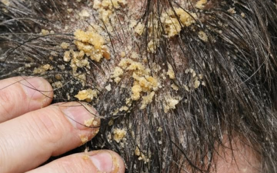 Mož ima glavo prekrito s temi debelimi, mastnimi rumenimi kosmiči in se ne more nehati praskati. Tako ga je nerodno iti v službo v takem stanju, mi pa tedne ne moremo priti k dermatologu. Doe