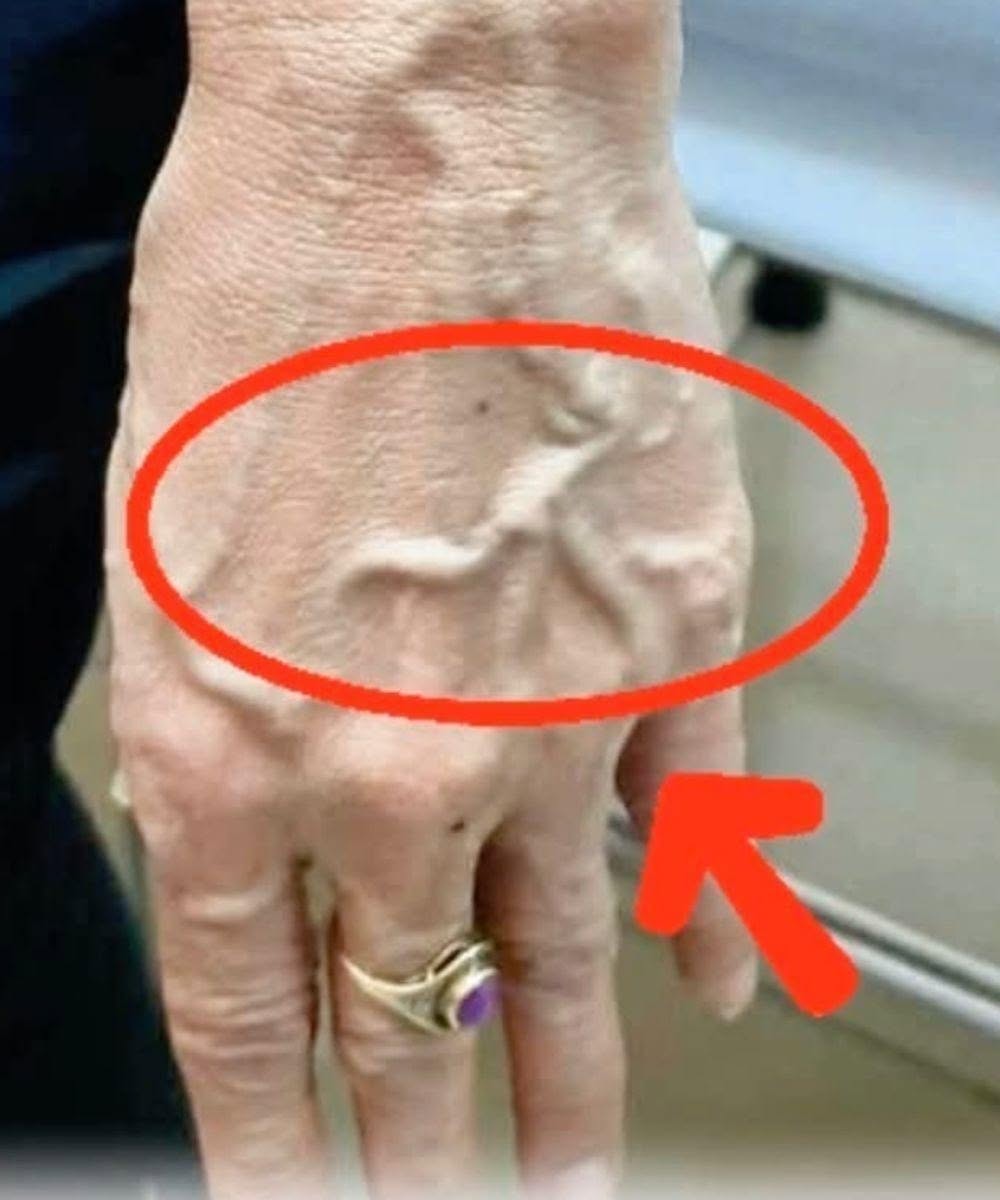 Če imate vidne žile, to pomeni, da ... Prikaži več