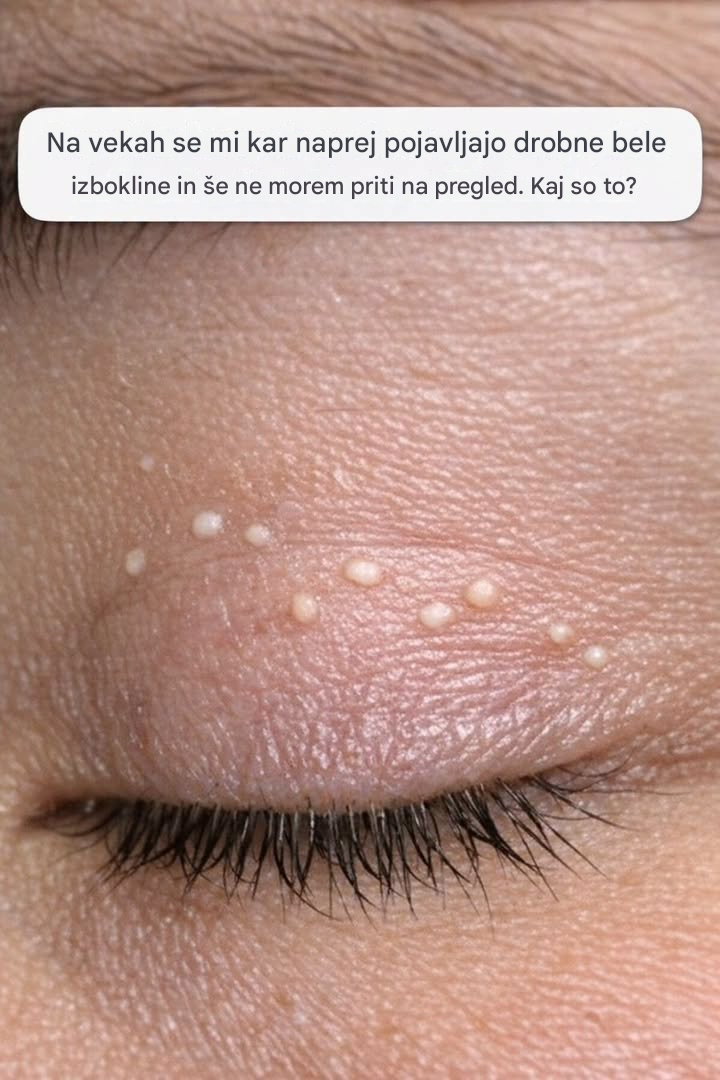 Na vekah se mi kar naprej pojavljajo drobne bele izbokline in še ne morem priti na pregled. Kaj so to?