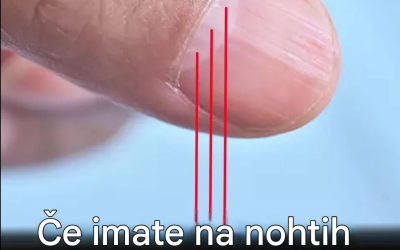 Zdravnik odkriva znak na vaših nohtih, ki lahko napoveduje vašo življenjsko dobo