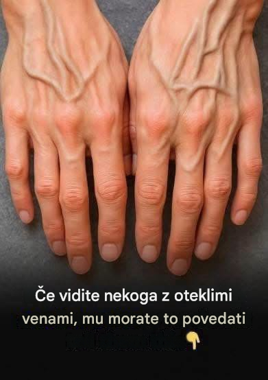Kaj v resnici pomenijo vidne žile? Razumevanje vzrokov in kdaj je treba biti pozoren