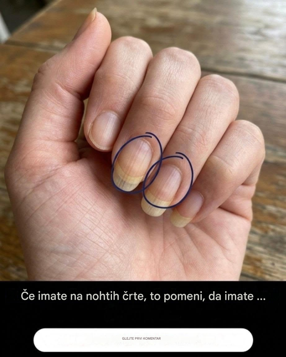 Če imate valove na nohtih, je to njihov pomen